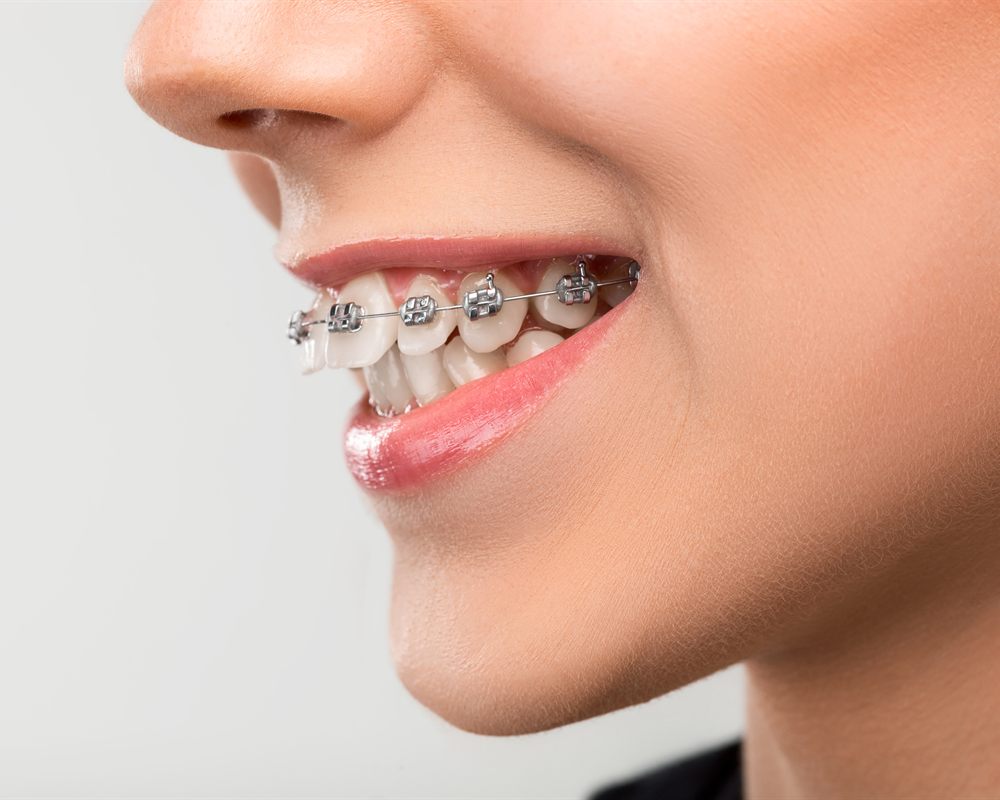 Ortodonție – Clinica Dentipo București